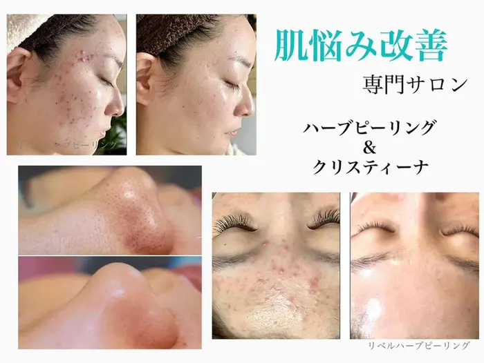 ハーブピーリング専門 BIOEL横浜(BIOEL横浜所属)のエステ・リラク