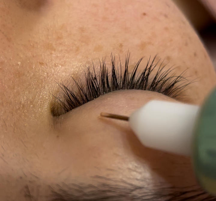 レーザーでは触れない目の周り、まぶたのシミも当店の低周波ペンシルで