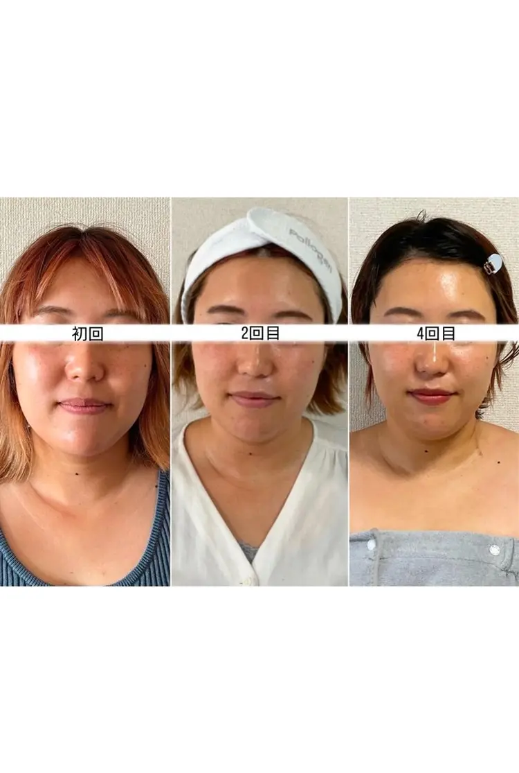 小顔＆肌質改善　お顔の印象の内観・外観1