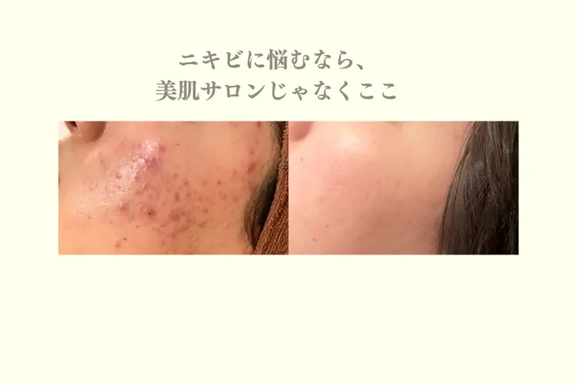 ニキビ特化型エステ 🍋最短で肌質改善の掲載