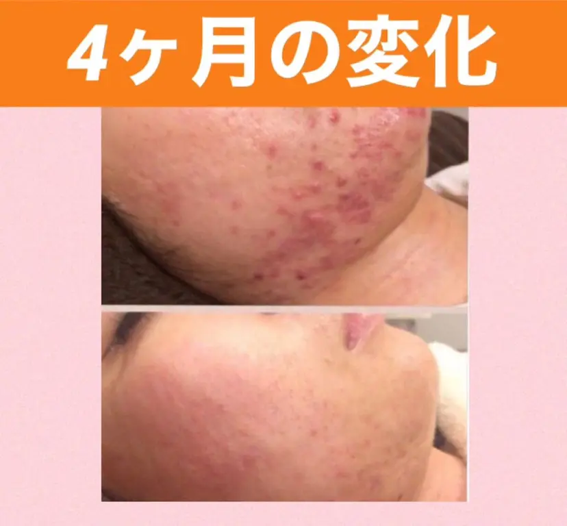 ニキビ専門 肌トラブル解消サロンの掲載