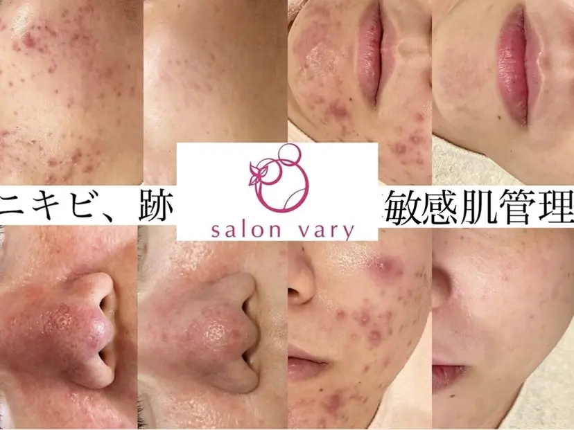 ニキビ•ニキビ跡改善 salon varyの掲載