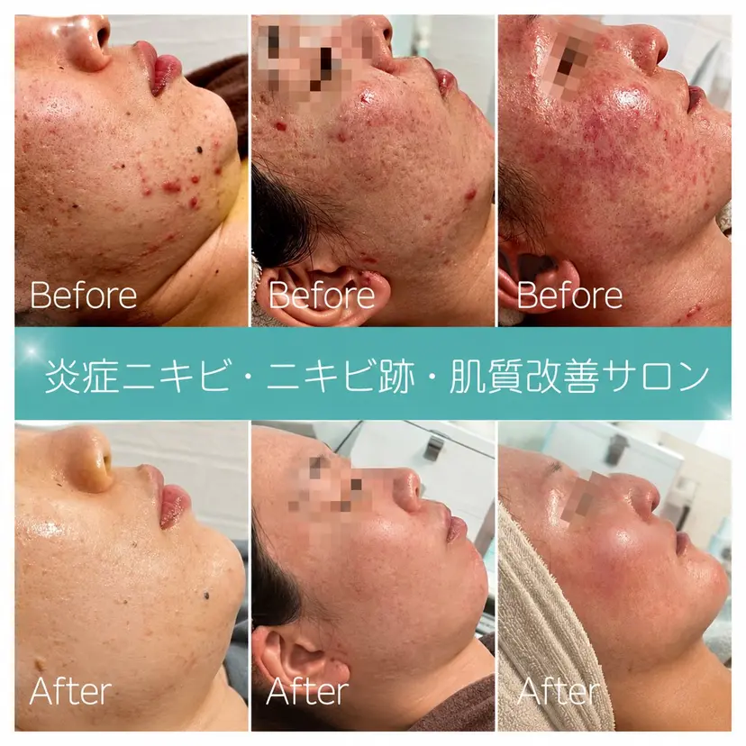 ハーブ/毛穴ケア 博多アンドナイン平尾の掲載