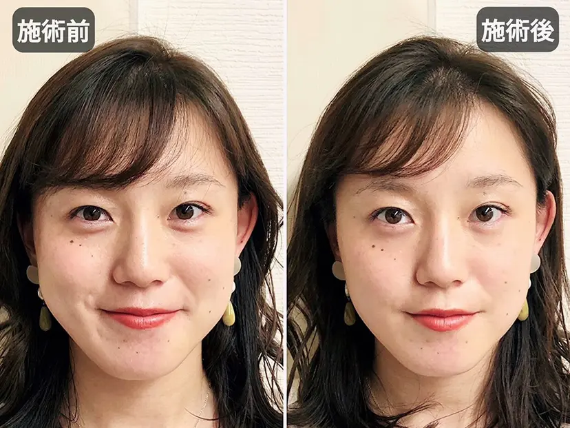 小顔美容鍼・首肩こり 山崎の掲載