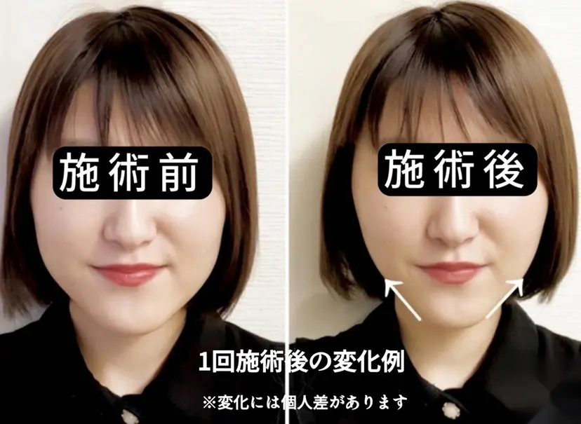 美容鍼・首肩こり 鍼灸師 山崎の掲載