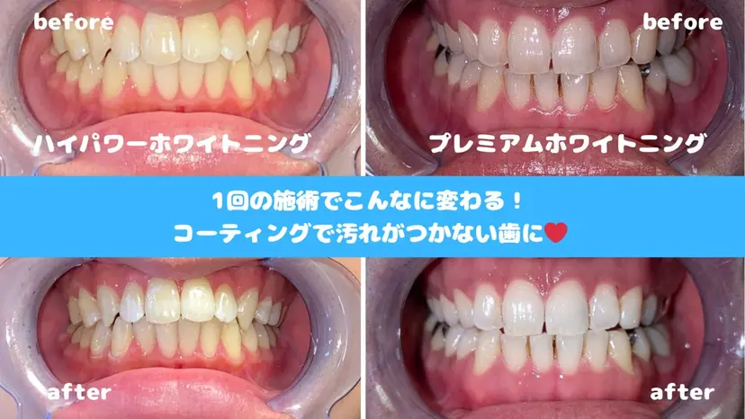 完全個室ホワイトニン グサロン「アトリエ」の掲載