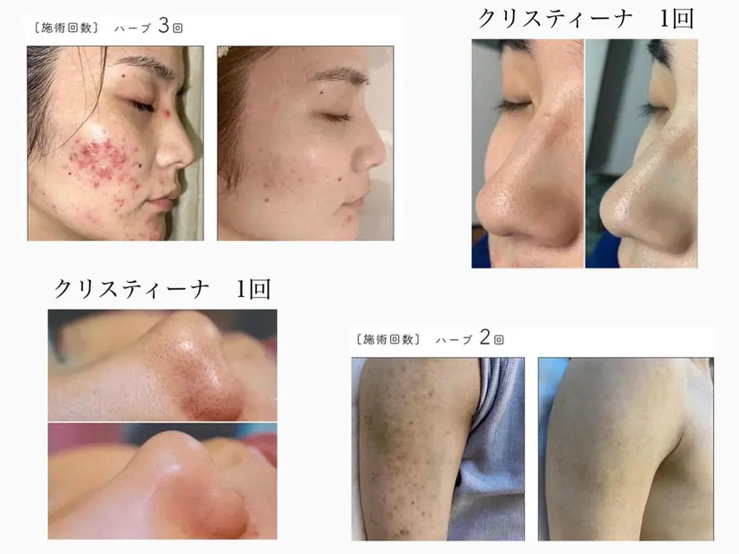 ハーブピーリング専門 BIOPLUS+川崎の掲載