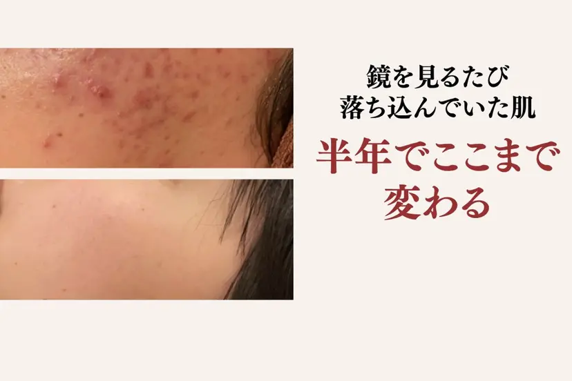 重度ニキビ専門🌼 ダウンタイムなしの掲載