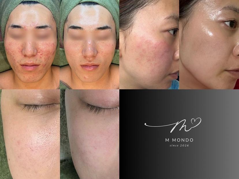 脱毛×肌質改善 M Mondoの掲載