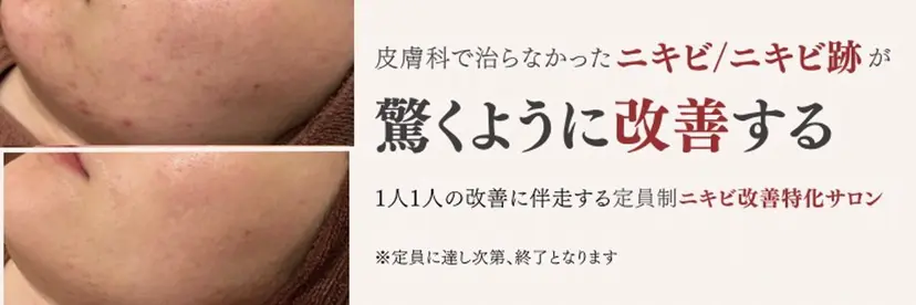 何をしても繰り返す ニキビ・ニキビ跡専門の掲載