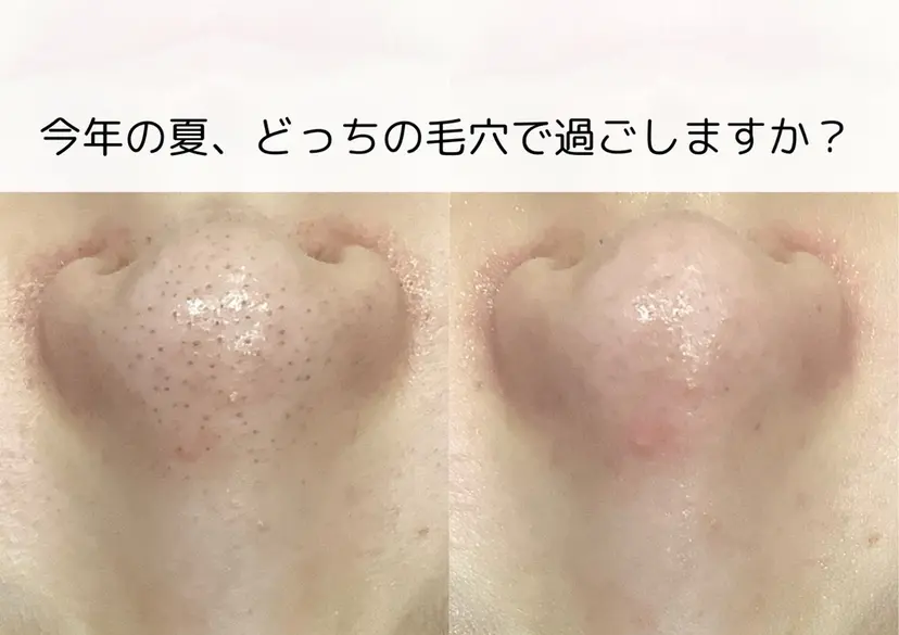 毛穴専門店Bebe 高崎 佐々木の掲載