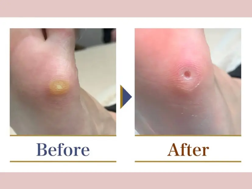 巻き爪補正店 大阪なんば店の掲載