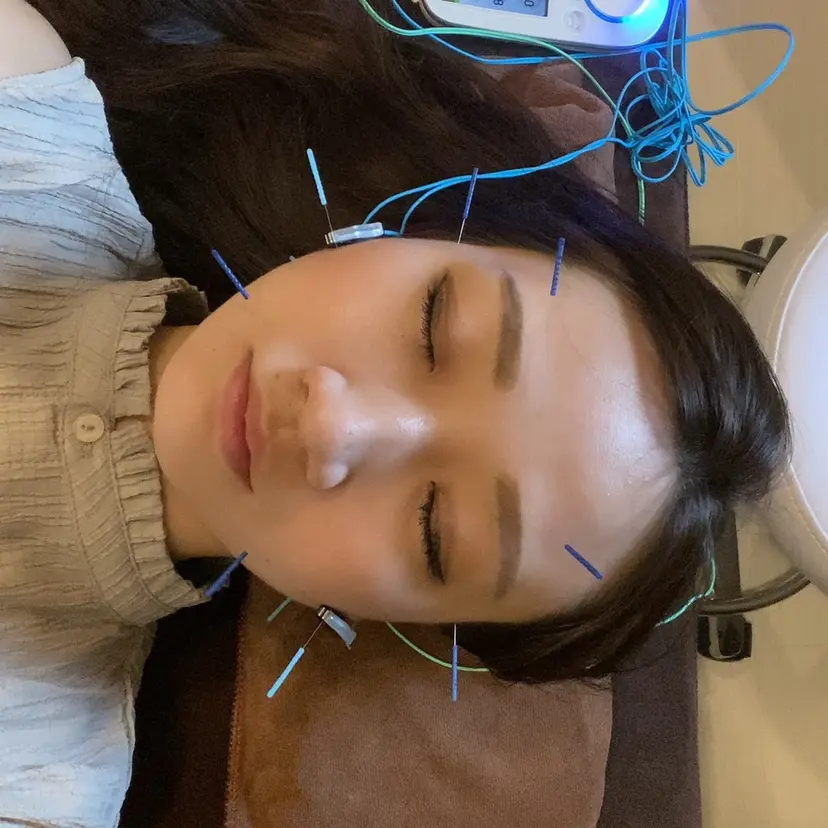 新宿/美容鍼/小顔 💆‍♀️大森はるなの掲載