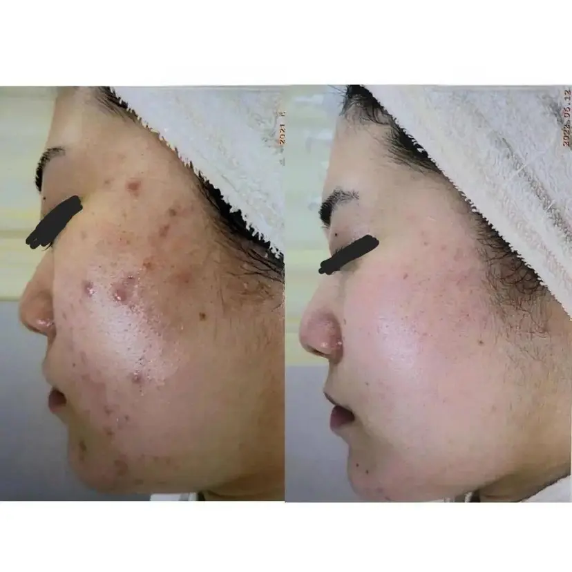 ニキビ・ニキビ跡専門 レゾン京橋店 の掲載