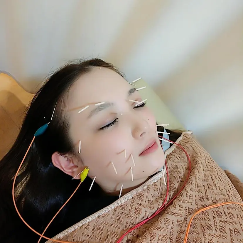 リフトアップ・たるみ ☆美容鍼小顔矯正の掲載