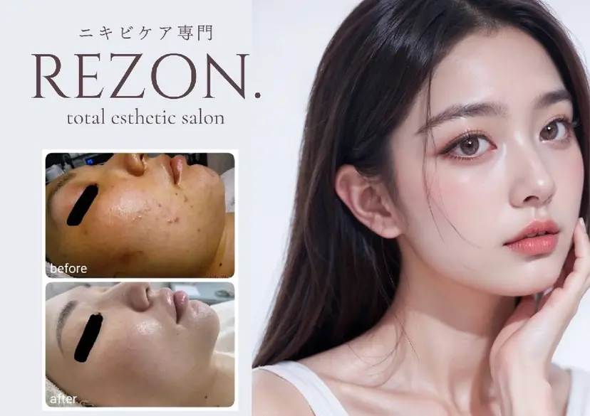 〈ニキビケアサロン〉 レゾン京橋店/ 浅川の掲載