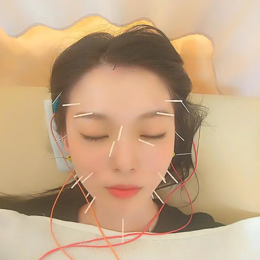 お顔のむくみたるみ 専門☆美容鍼小顔矯正の掲載