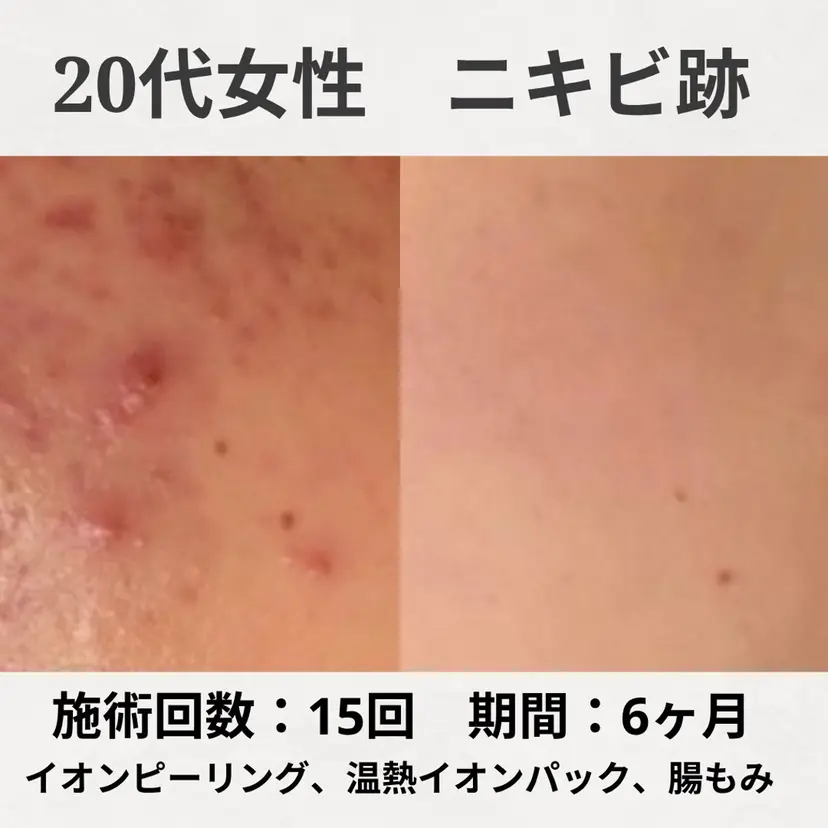 ニキビ跡改善専門🔥 医療にはできない改善の掲載