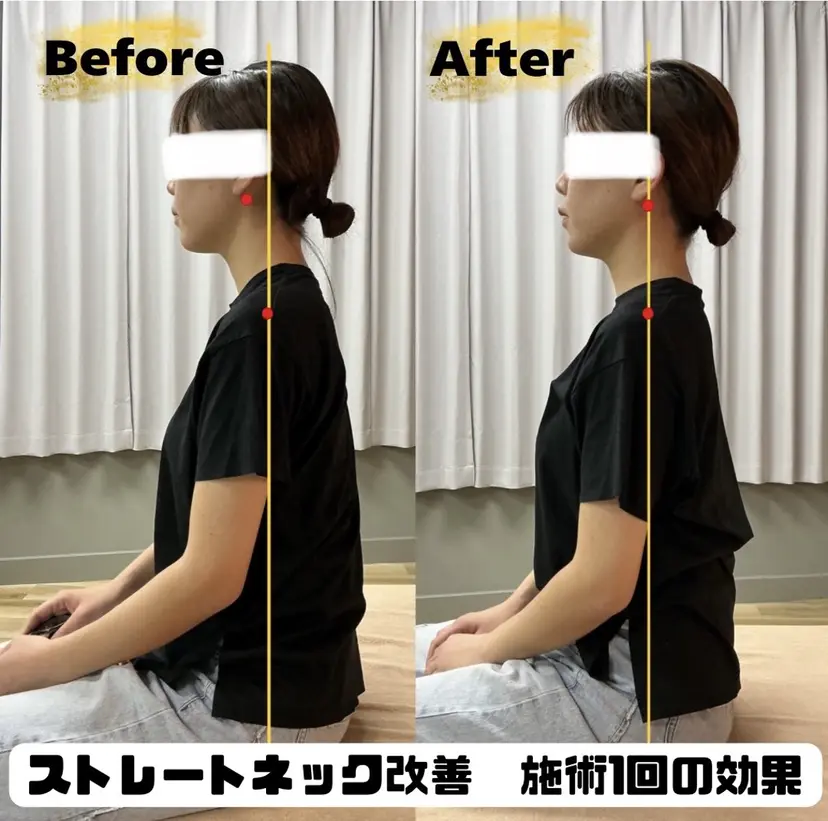 ストレートネック改善 🌸りこの掲載