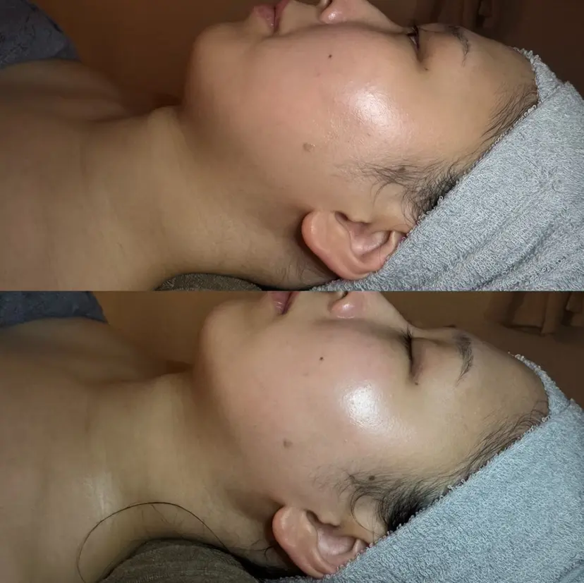 Lupinus 小顔矯正の掲載