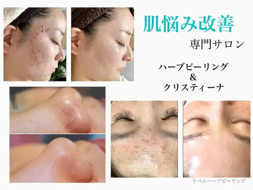 ハーブピーリング専門 BIOEL横浜の掲載