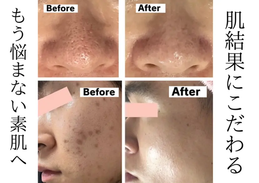 毛穴・ニキビ専門 エステグレースティーの掲載