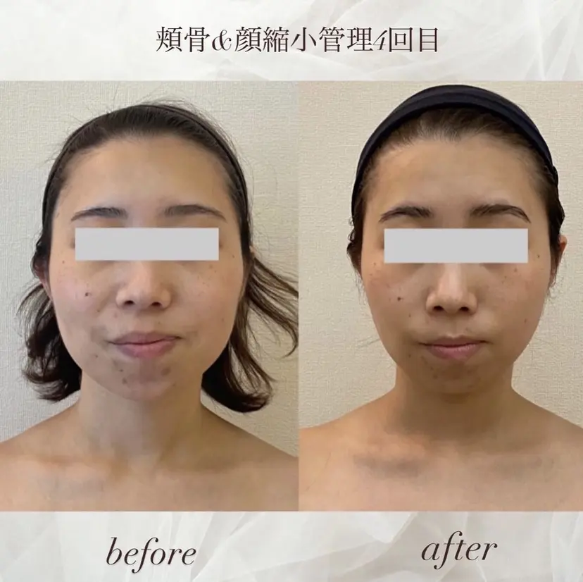 整形級の変化👀 最新✨韓国小顔管理の掲載