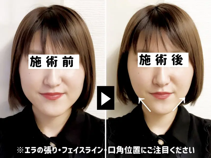 小顔美容鍼専門サロン 渋谷YZの掲載