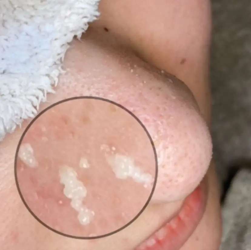 最速 毛穴シミ改善 いくえの掲載