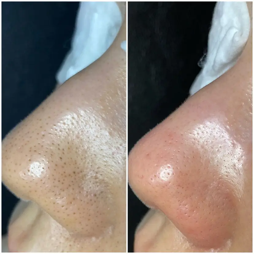 毛穴専門店【各務原】 天使の毛穴の掲載