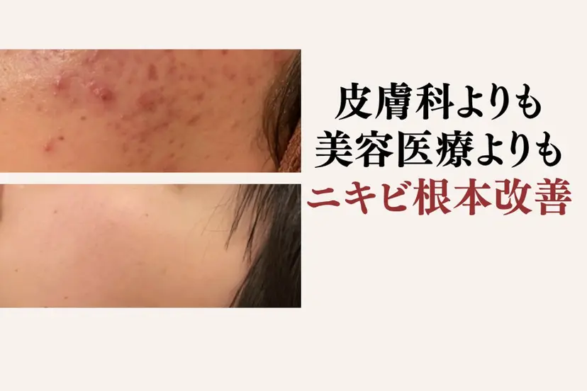 重度ニキビ専門🌷 ダウンタイムなしの掲載