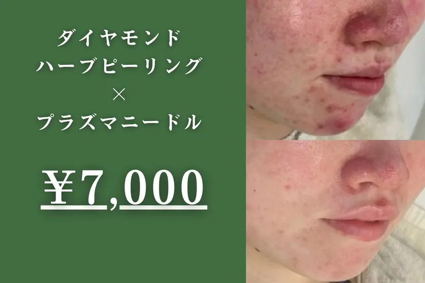 韓国肌管理&小顔 ＩＲＯＨＡの掲載