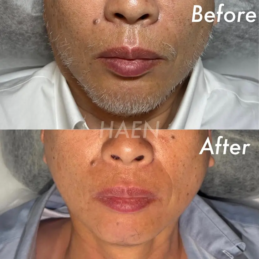 美容電気脱毛サロン HAENの掲載