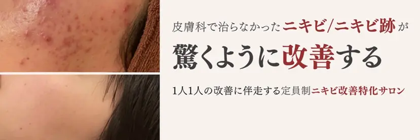 重度ニキビ専門🌷 ダウンタイムなしの掲載
