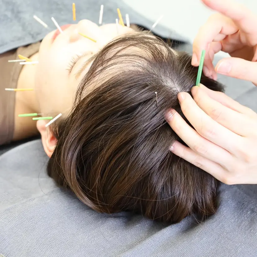 ニキビ特化美容鍼 ×ハーブピーリングの掲載