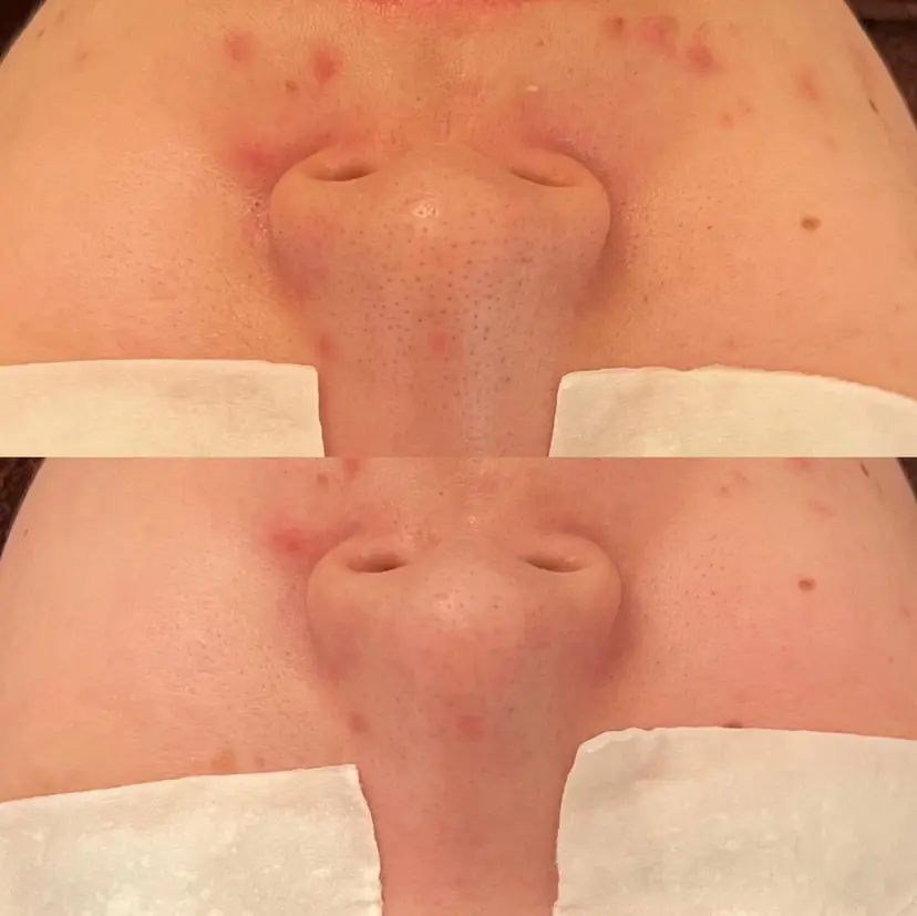 毛穴ケア/毛穴診断/ 毛穴洗浄〔心斎橋〕の掲載