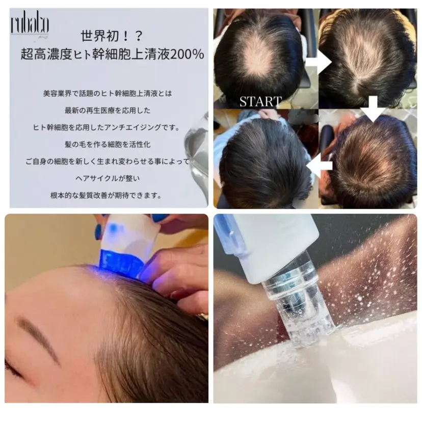 抜毛 薄毛 白髪 頭皮改善 柳沢慶の掲載