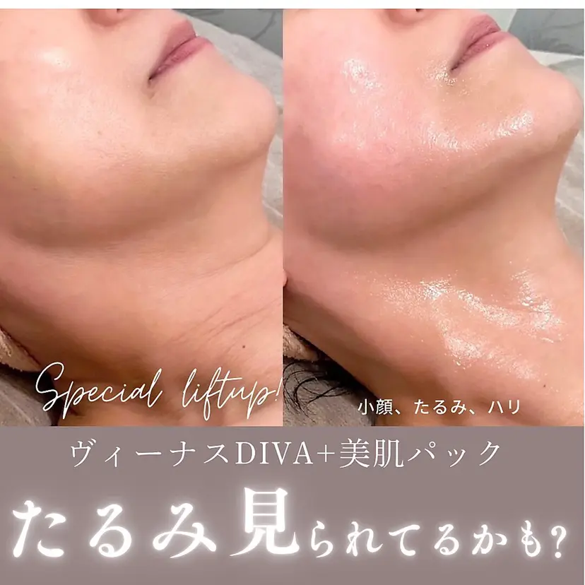 痩身ハイパーナイフ 小顔フェイシャル痩身の掲載