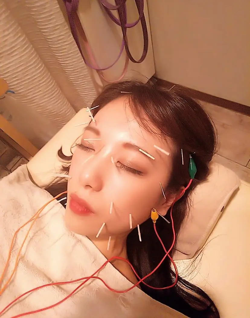 むくみたるみ専門☆ 美容鍼・小顔矯正の掲載