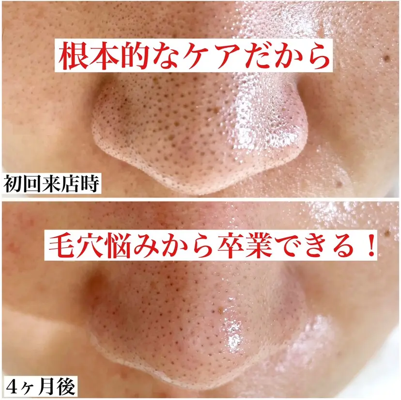 毛穴ケア専門サロン レーヌの掲載