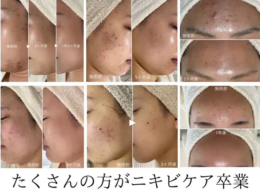 ニキビ・毛穴・ フェイシャル専門店の掲載