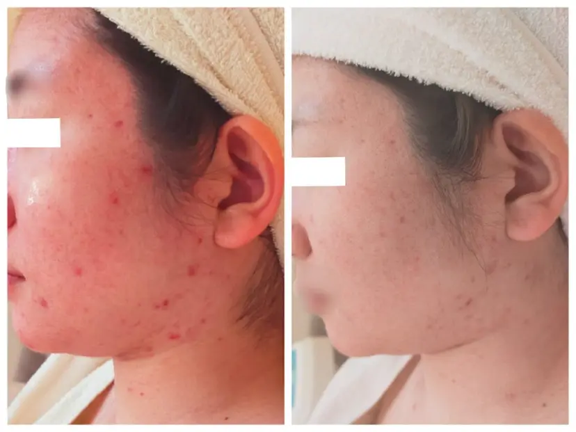 ニキビ肌ケアサロン Happy の掲載