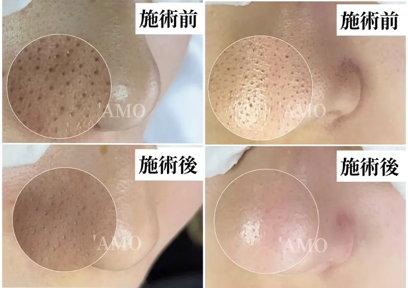 姫路/毛穴専門店 'AMOの掲載