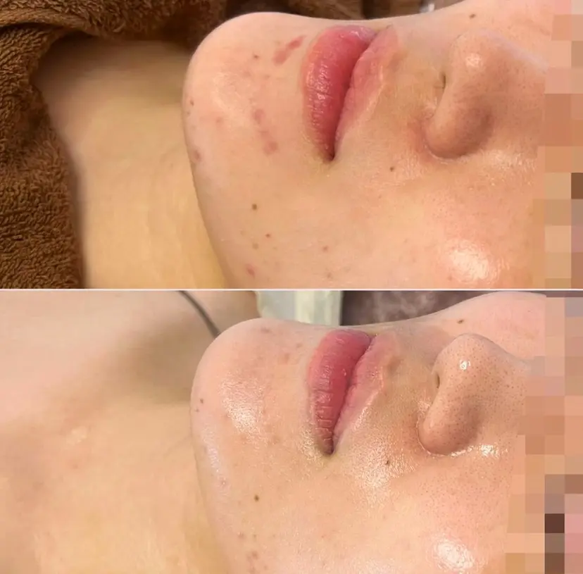 肌質改善/小顔/ ナスサロ/Yuiの掲載