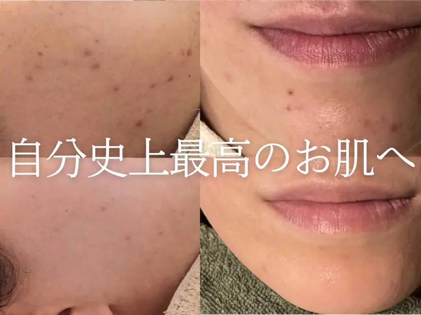 毛穴ハーブピーリング gypsophiraの掲載