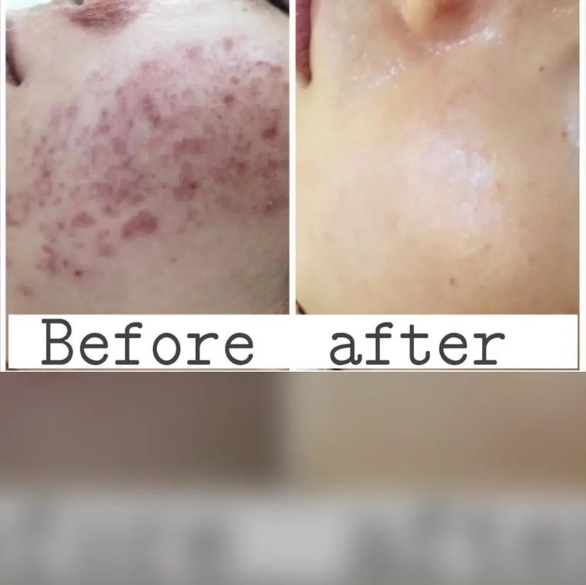 ニキビ&跡改善サロン オーナー光木の掲載