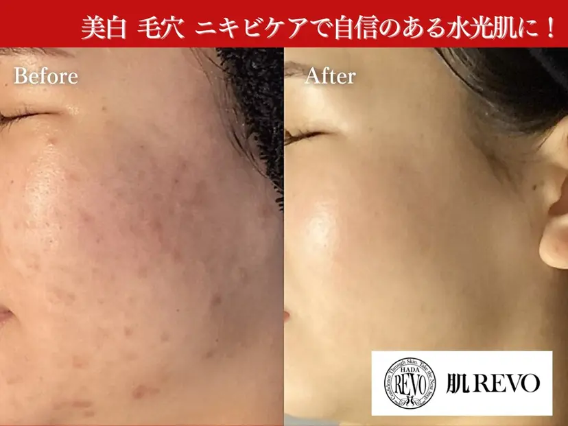 池袋毛穴ニキビ改善 ハーブピーリングの掲載