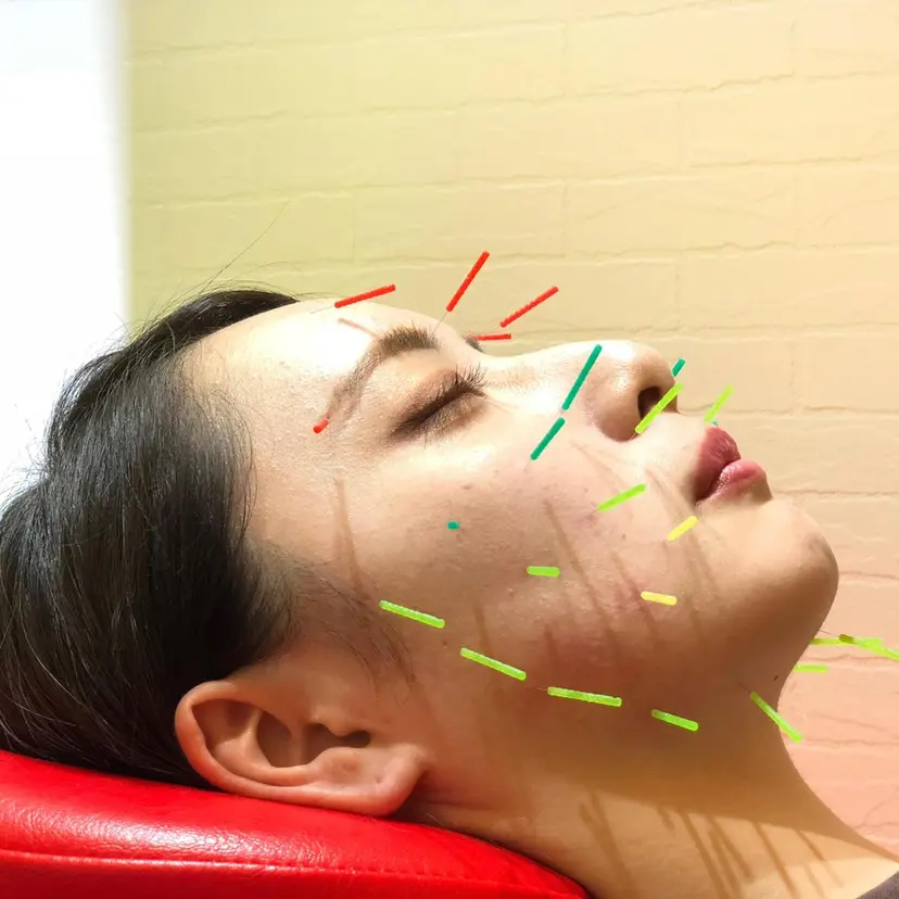 🌈リフトアップ🫶 美容鍼 🌈 サノの掲載