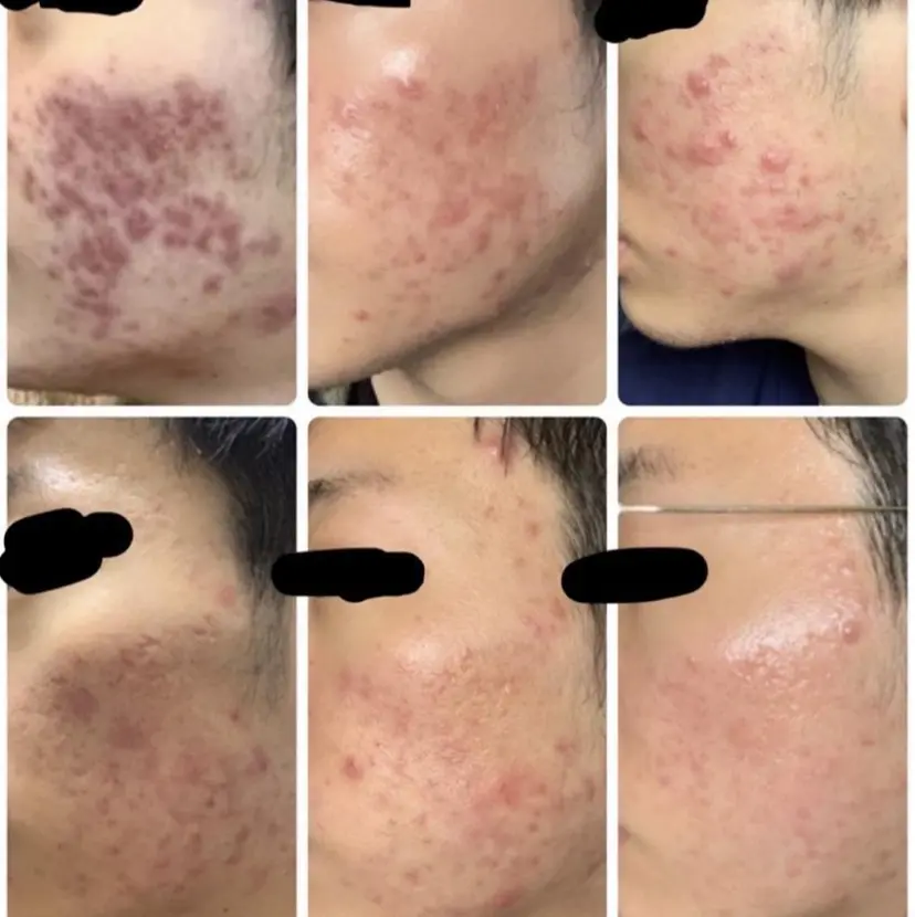 肌質体質を変えて すっぴん肌にの掲載