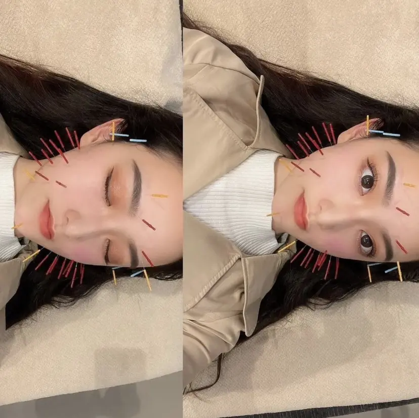 LUANA 美容鍼の掲載